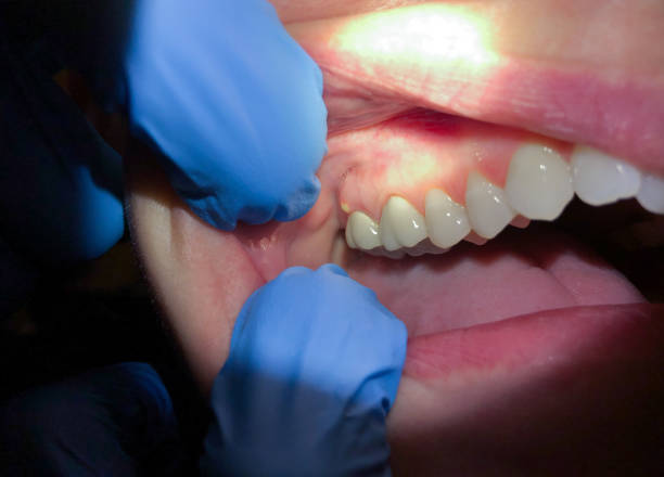 Best Dental Abscess Treatment in Port Hueneme, CA